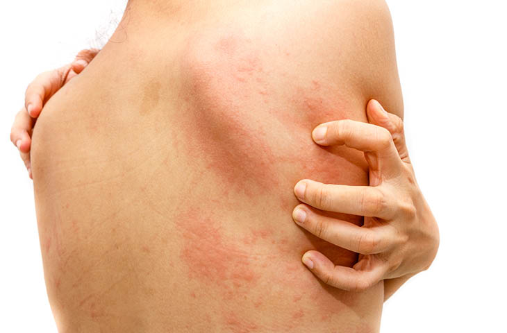 Alergias Cutáneas – Centro del Alérgico